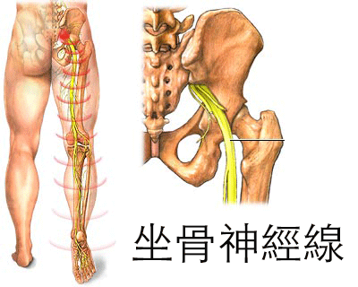 坐骨神經痛檢查